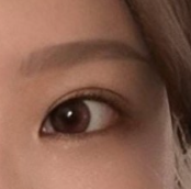 หลังผ่าตัดแก้ไขตารู้สึกมีชีวิตชีวาขึ้น ㅠ