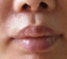 ลดความยาวร่องใต้จมูกด้านข้าง