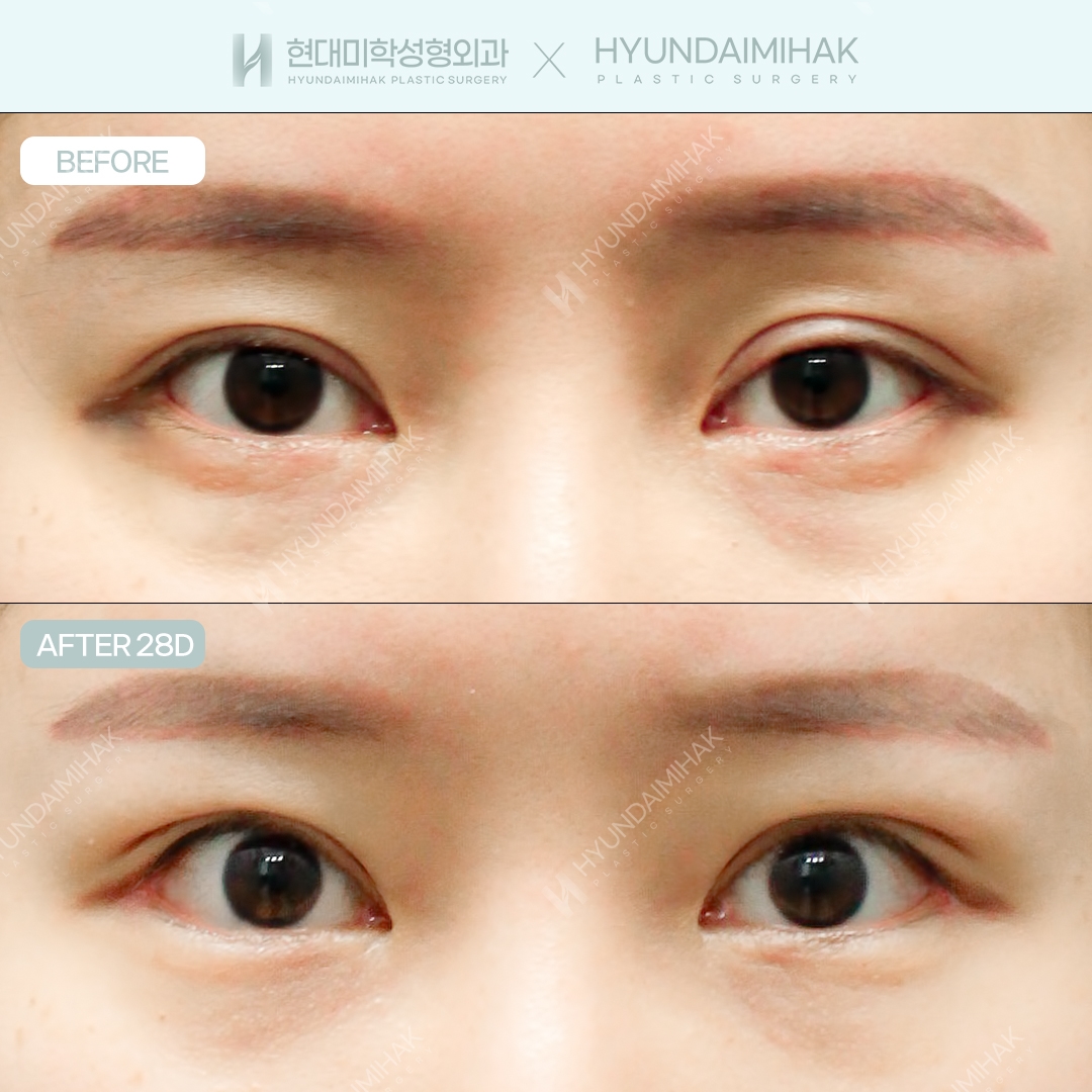 [ศัลยกรรมตาแก้ไข] แก้กล้ามเนื้อตาแบบกรีด + เปิดหางตาแบบคู่
