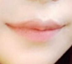 ผ่าตัดยกมุมปากกับคุณหมอฮง~~~~