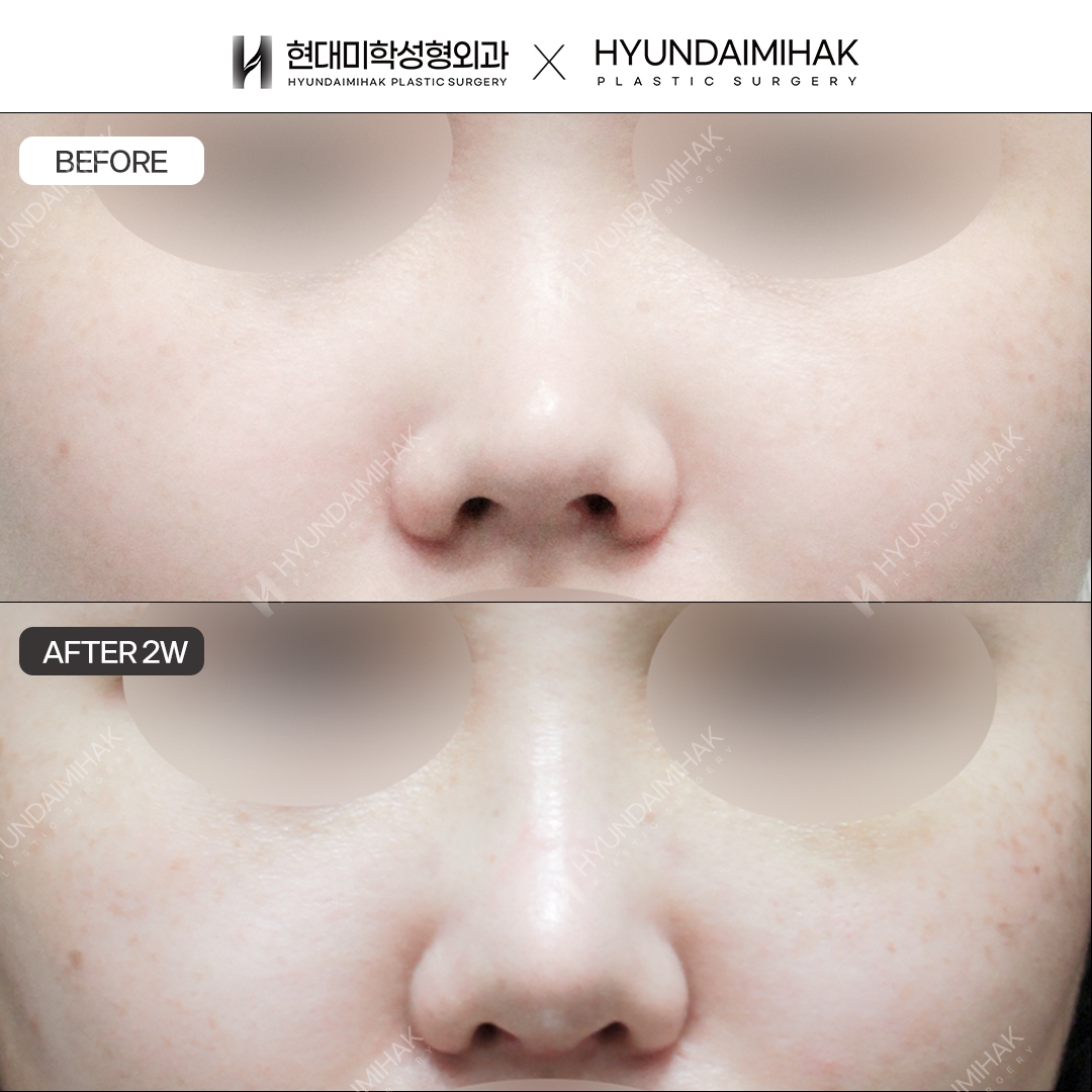 [ศัลยกรรมแก้จมูกสั้น] สันจมูก + ปลายจมูก หลังทำ 2 สัปดาห์