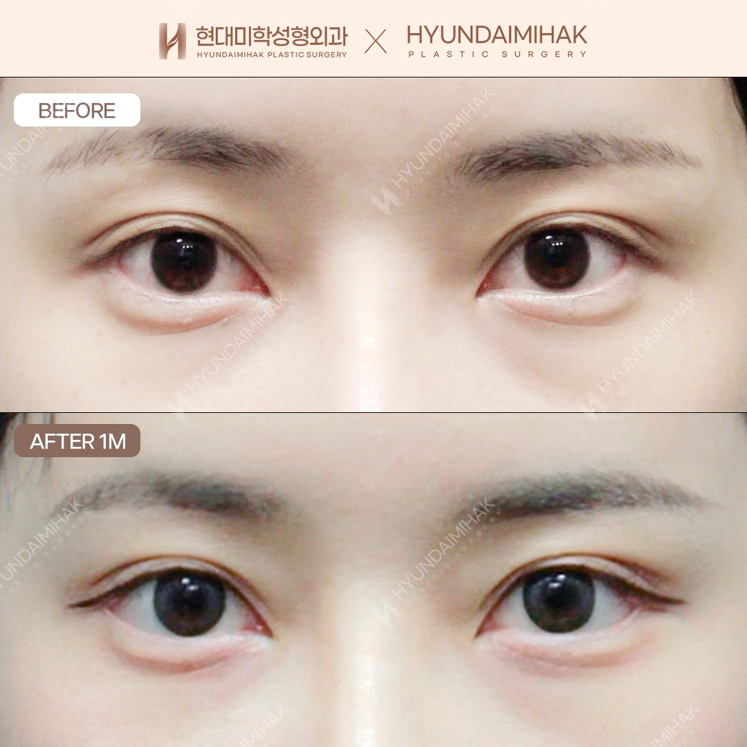 แก้กล้ามเนื้อตาแบบไม่กรีด + เปิดหางตาแบบคู่