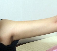 แขนของฉันเล็กลงครึ่งหนึ่งแล้ว