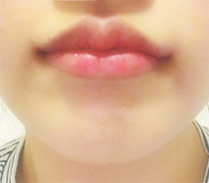 แนะนำศัลยกรรมริมฝีปากมากๆ ฮิฮิ