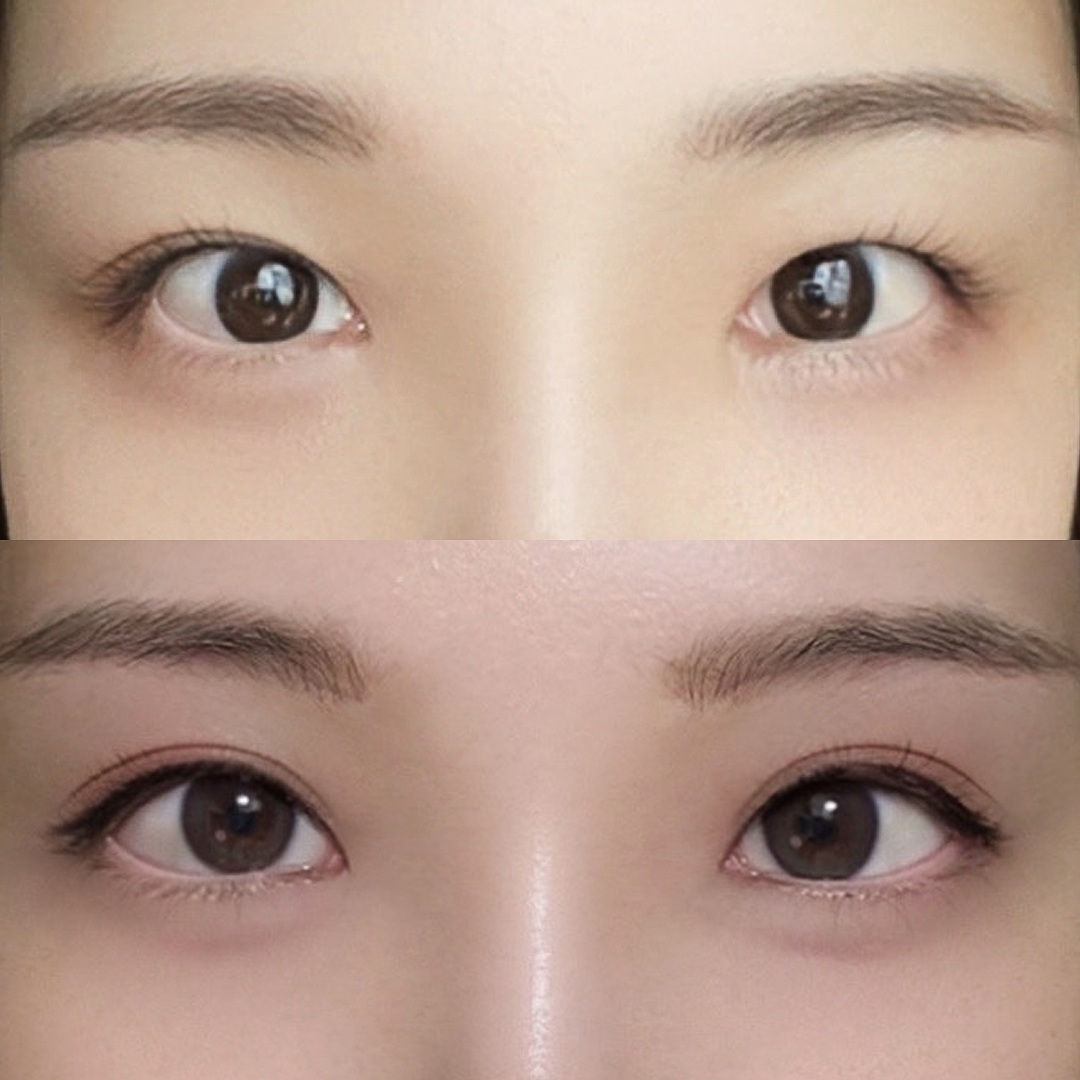 แก้ตาที่คลาย: แก้ตาสองชั้น + ปรับกล้ามเนื้อตา + เปิดหางตาและใต้ตา