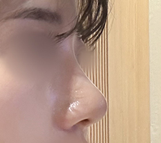 ไปจัดการจมูกฮัมพ์มาแล้วค่ะ