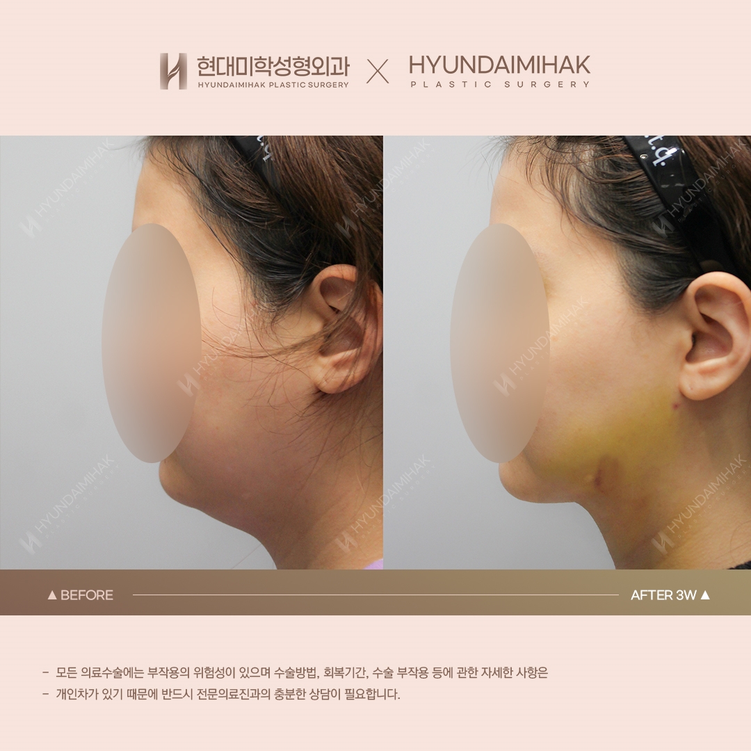 [ยกกระชับ] ร้อยไหมเหนียงใต้คาง สัปดาห์ที่ 3