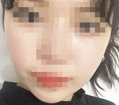 ลดโหนกแก้ม