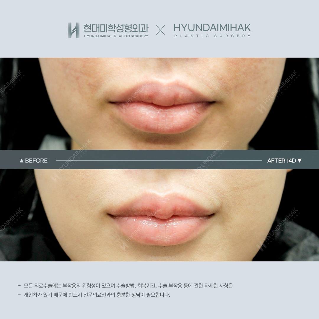 [ศัลยกรรมริมฝีปาก] ศัลยกรรมริมฝีปากคิวปิด วันที่ 14