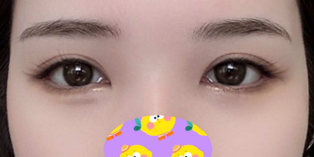 If your eyes look blocked, definitely do lateral and lower canthoplasty