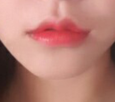 Lip surgery at Hyundai Thailand is seriously highly recommended;