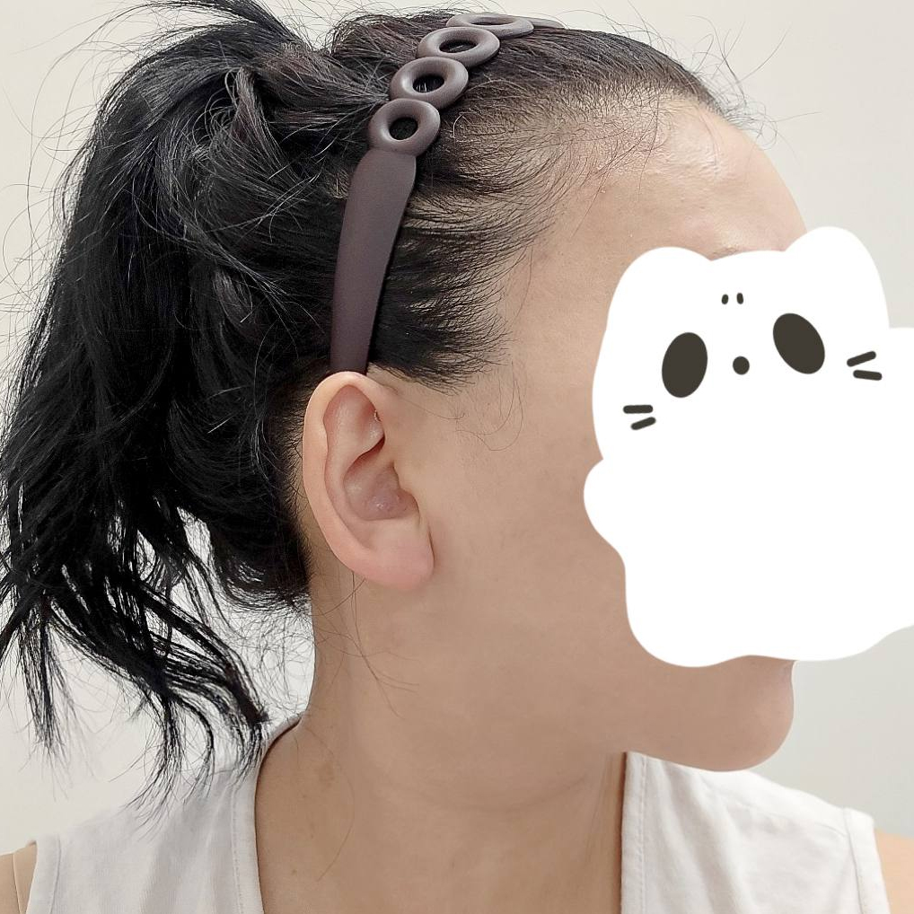 ดูดไขมันหน้า+เหนียงระดับตำนาน ใครกำลังดูดไขมันหน้า/คางต้องอ่าน
