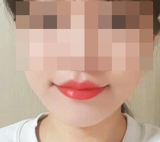 มุมปากคิวปิด+ตุ่มริมฝีปาก