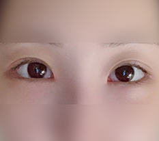 ถึงว่าทำไมถึงทำดูอัลแคนโธพลาสตี ฮ่าๆ