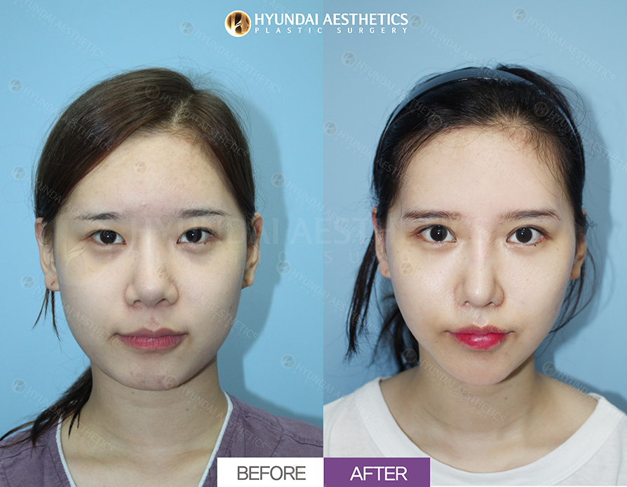แก้ตาสองชั้นแบบกรีด + แก้ไขกล้ามเนื้อตา + เปิดหัวตา + เปิดหางตาแบบ Dual