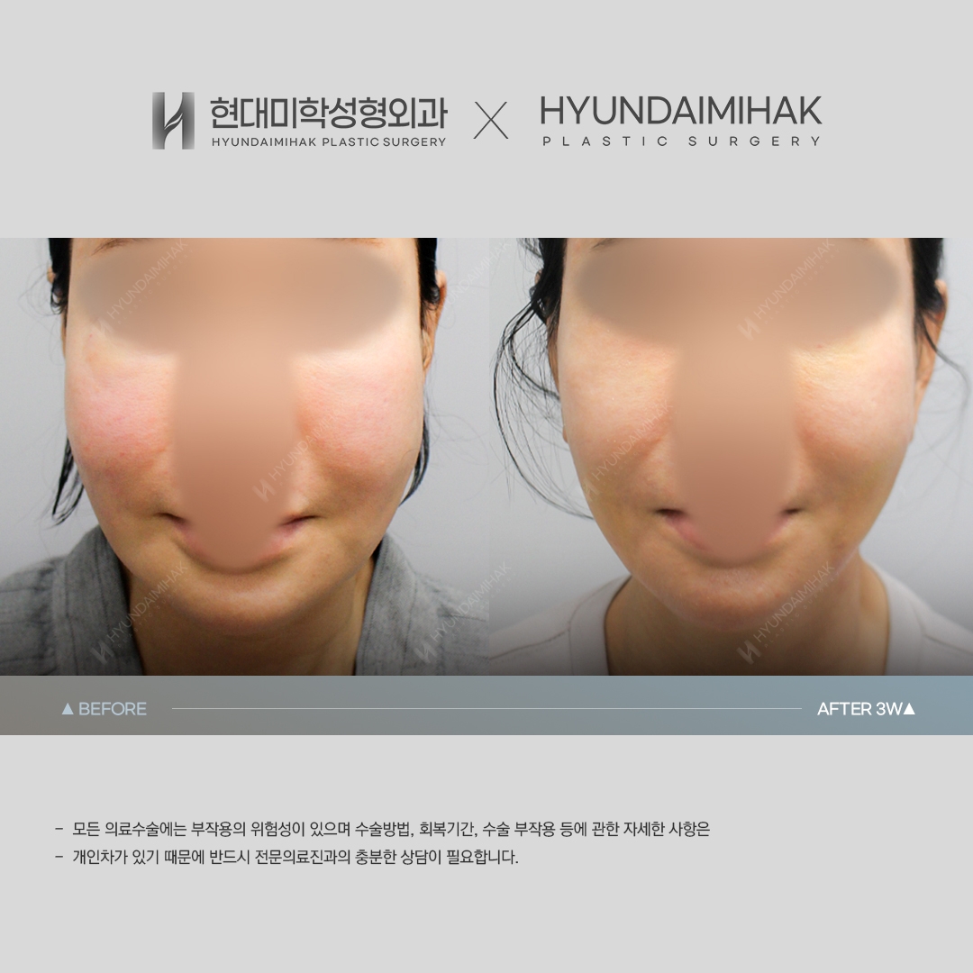 [ศัลยกรรมหน้าเด็ก] ร้อยไหม 3 สัปดาห์