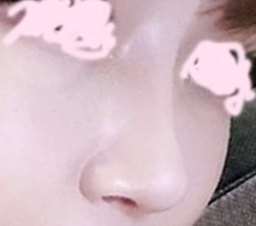 รีวิวหลังแก้จมูกค่ะ~