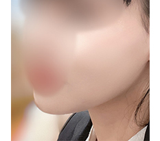 ฉีดสลายไขมันได้ผลดีมาก