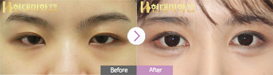 เย็บจุด, เปิดหัวตาและหางตา