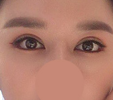 ตาแก้ครบหนึ่งเดือน ฮ่า แบบนี้ถือว่าสำเร็จใช่ไหมคะ?? ^^