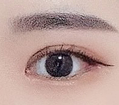 บวมยุบลงเยอะมากและดูเป็นธรรมชาติขึ้นค่ะ