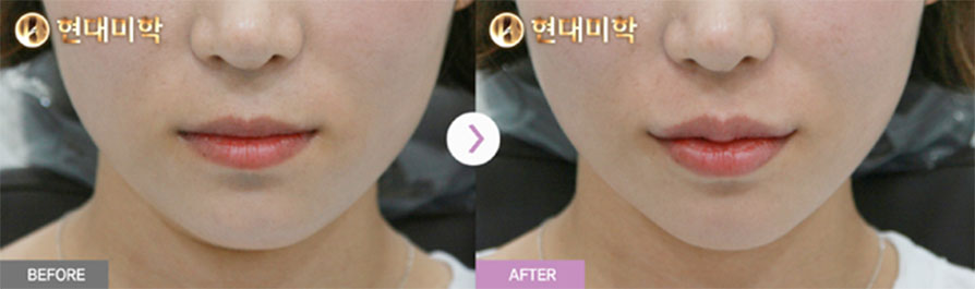 ฟิลเลอร์ปาก