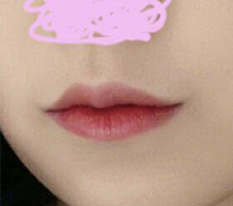 พอใจมากทั้งรูปทรงและแผลเป็นของการผ่าตัดยกมุมปาก ฮ่าๆ