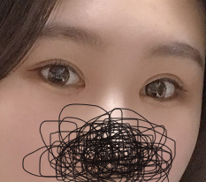 They really deserve the nickname canthoplasty specialist~ Hyundai Thailand is the best!