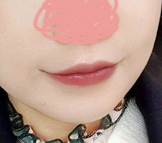 ลงรีวิว 2 เดือนหลังผ่าตัดมุมปากไปแล้ว พอครบ 3 เดือนก็มาลงรีวิว 3 เดือนด้วย ><