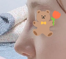 มารีวิววันที่ 7 หลังทำจมูกค่ะ
