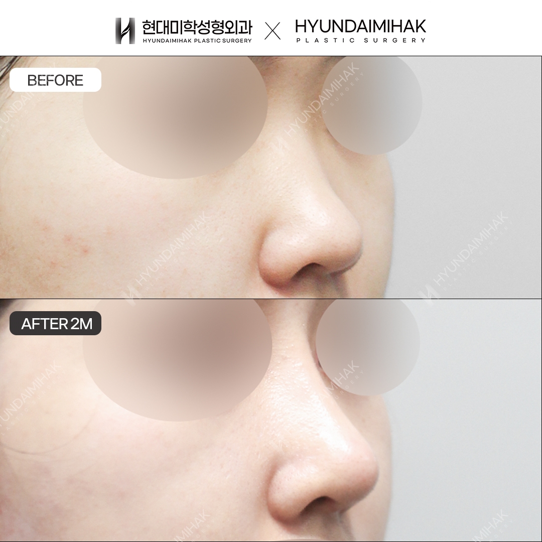 [เสริมจมูกโด่งสำหรับจมูกเตี้ย] สันจมูก + ปลายจมูก ครบ 2 เดือน