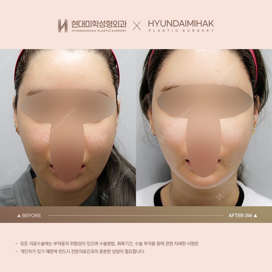 [ยกกระชับ] ร้อยไหมเหนียงใต้คาง ครบ 3 สัปดาห์