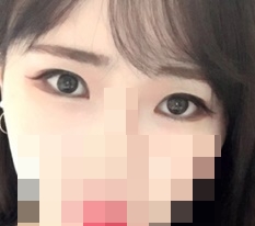 Totally satisfied with Hyundai Thailand eye-shape correction♥