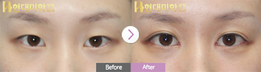 ศัลยกรรมตา, เย็บจุด, เปิดหัวตา หางตา และเปิดใต้ตา