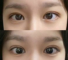 ทำผ่าตัดแก้ไขตาสองชั้นแบบ Natural Adhesion แล้วค่ะ