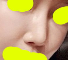 แก้จมูก ภารกิจสำเร็จเรียบร้อย ~_~