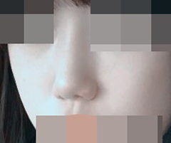 ฉันทำศัลยกรรมปีกจมูกแล้วค่ะ!!