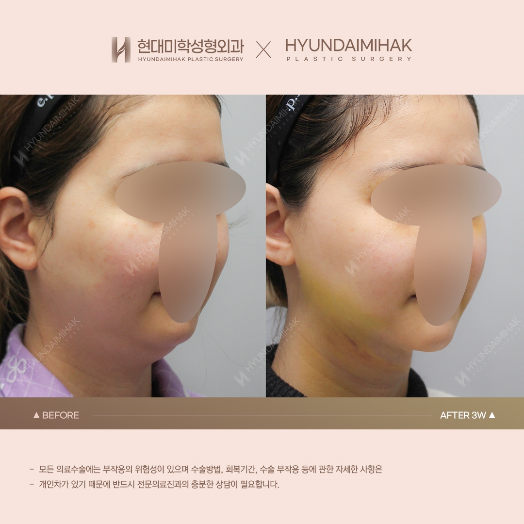 [ยกกระชับ] ร้อยไหมเหนียงใต้คาง สัปดาห์ที่ 3