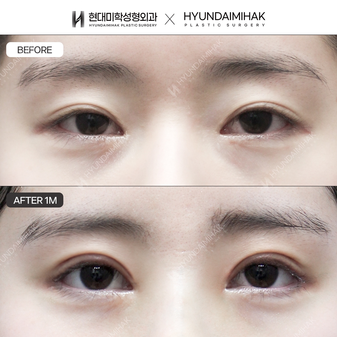 [ศัลยกรรมตาแก้ไข] แก้ตาสองชั้นแบบกรีด + เปิดหางตาแบบ Dual