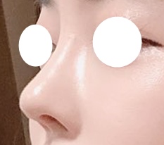 เพราะศัลยกรรมจมูก เลยมีแต่คนชมว่าสวยขึ้นมาก