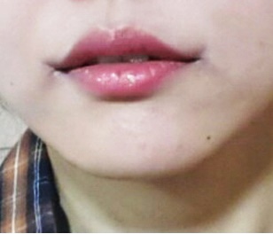 ผ่าตัดมุมปากน่าทึ่งมากเลย!!