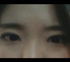 ทำผ่าตัดหัวตาและแก้ไขรูปตาแล้วค่ะ!