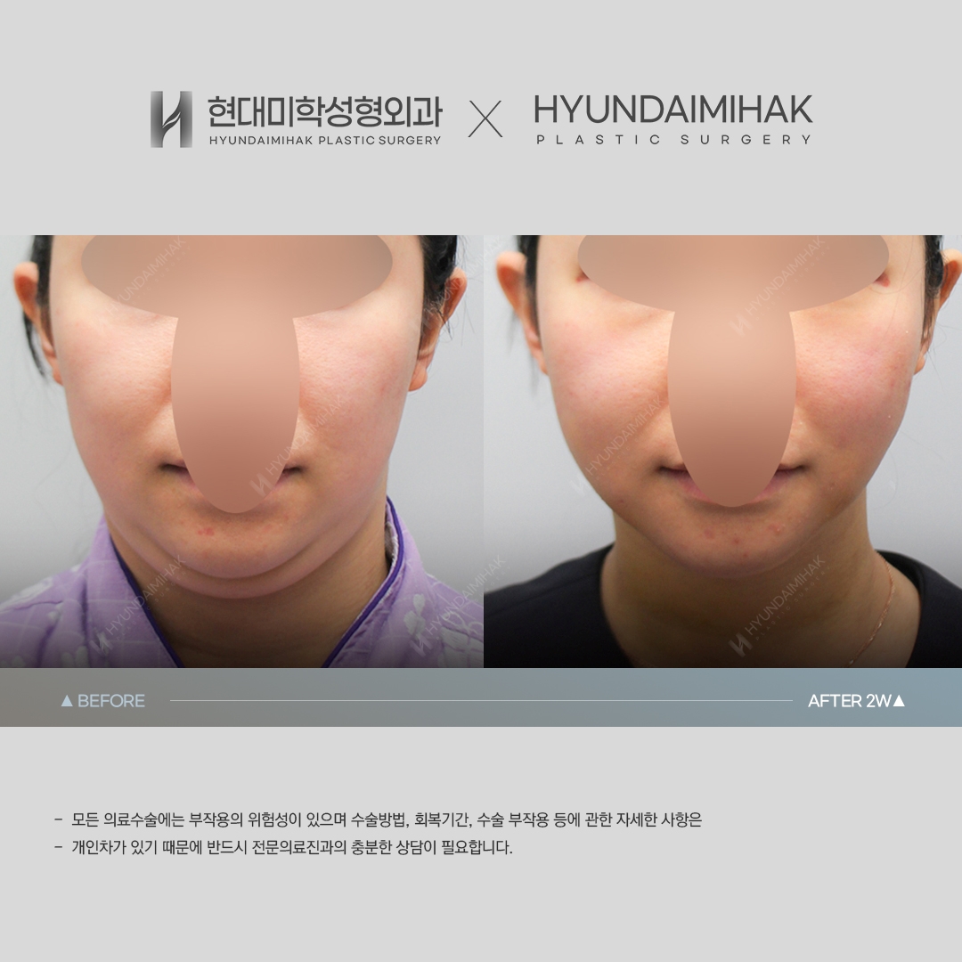 [ลิฟติ้ง] ร้อยไหมยกเหนียง ครบ 2 สัปดาห์