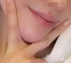 หลังทำปลายคาง หน้าเรียวขึ้นเป็นเรื่องพื้นฐาน แถมลุคเปลี่ยนไปด้วย