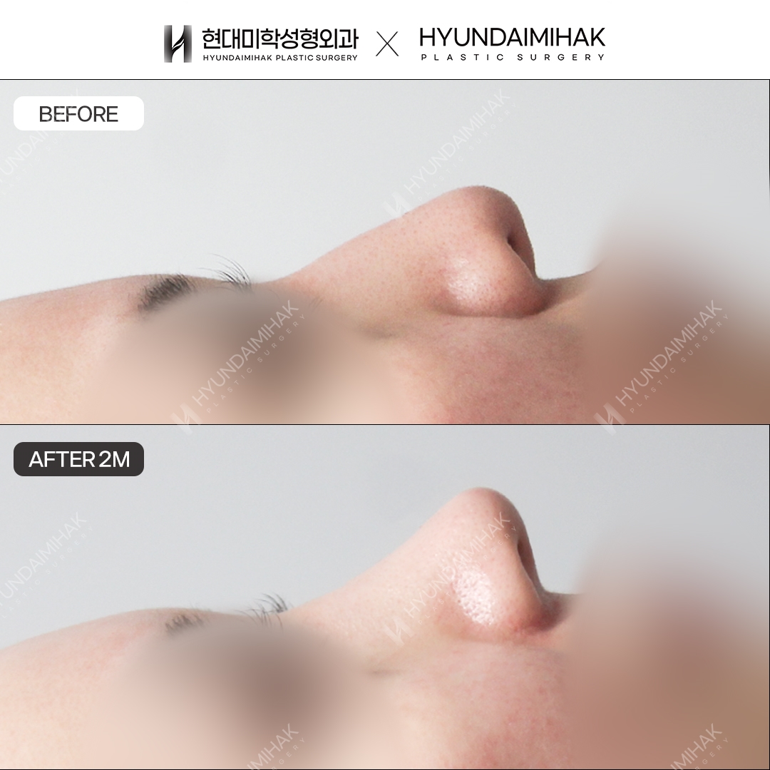 [แก้จมูกฮัมพ์] สันจมูก + ปลายจมูก ครบ 2 เดือน