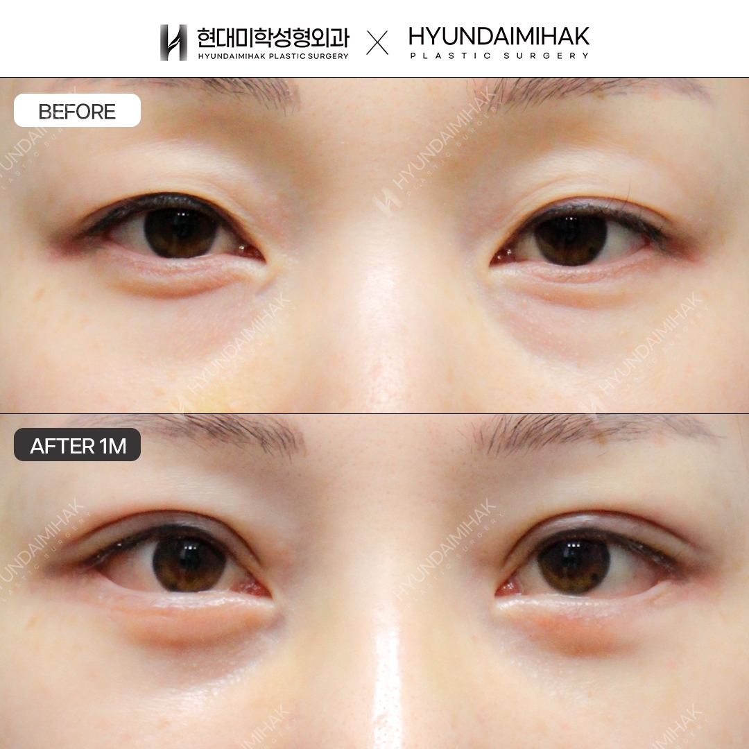 ผ่าตัดกรีดทำตาสองชั้น + แก้กล้ามเนื้อตา + เปิดหางตาแบบคู่