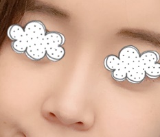 หลังทำจมูกก็มีความรักแล้วค่ะ~