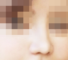 ชอบผลการผ่าตัดจมูกมากๆ