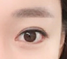 I had revision canthoplasty at Hyundai Thailand, the best~