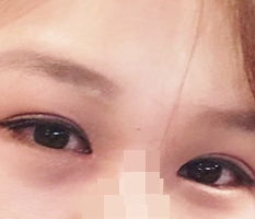 กรีดตา แก้กล้ามเนื้อตา เปิดหัวตา เปิดหางตาแบบคู่
